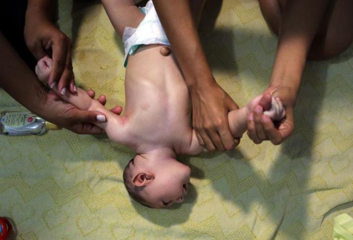 ילד הסובל מתסמיני זיקה, ברזיל (צילום:  רויטרס)