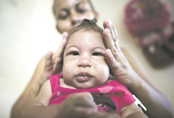 תינוק שנדבק בווירוס הזיקה  (צילום:  רויטרס)