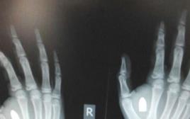 צילום הרנטגן שהראה קליע בכף היד  (צילום: דוברות טרם)
