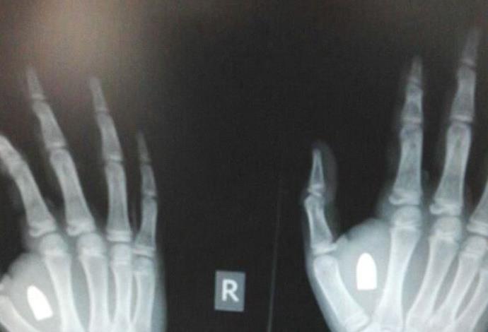 צילום הרנטגן שהראה קליע בכף היד  (צילום:  דוברות טרם)